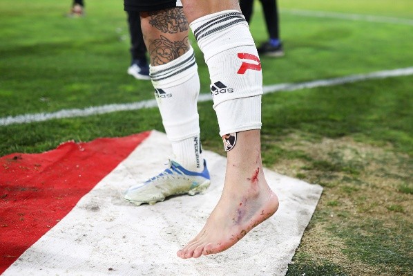 Así quedó el pie y el tobillo de Maxi Falcón tras planchazo recibido por parte de Cris Martínez el sábado. | Foto: Agencia UNO.